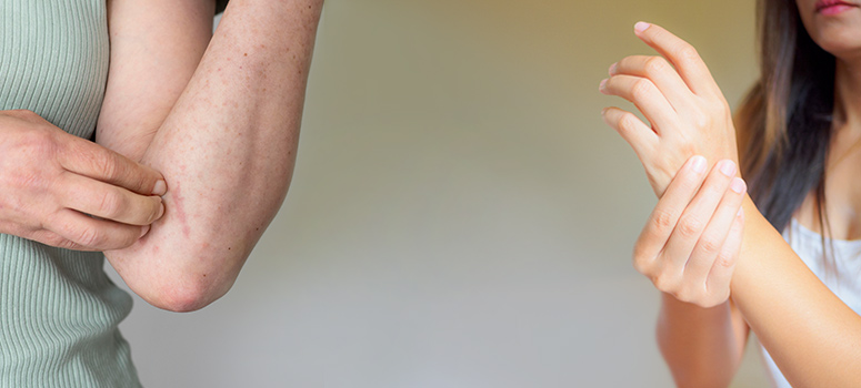 'सोरायसिस की गंभीरता और सोरायटिक गठिया के बीच क्या संबंध है | '